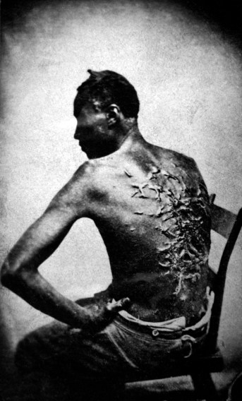 Whipped American slave Gordon, 1863